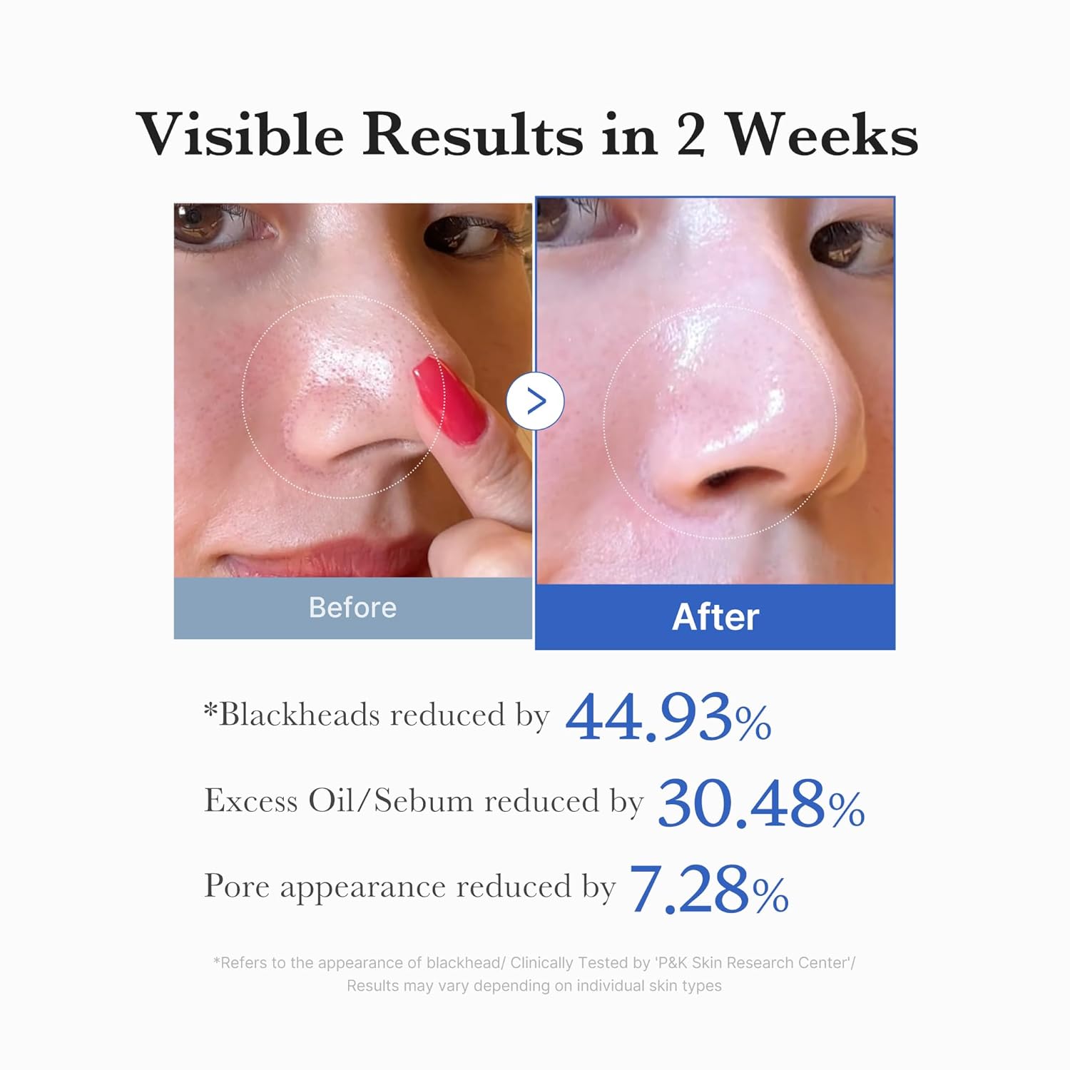 Clinical skincare blemish before and after results of Medicube Zero Pore Pad 2.0